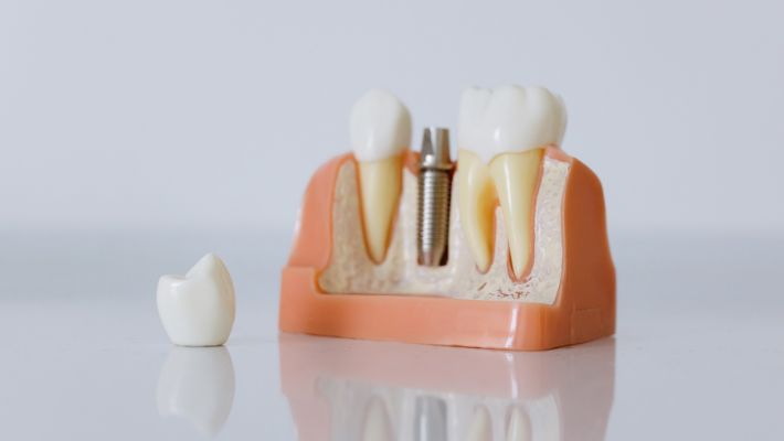 Dental Implants: A Revolution in Smile Restoration in Marrakech