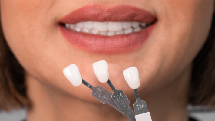 The Veneer Removal Process: What Happens Next?